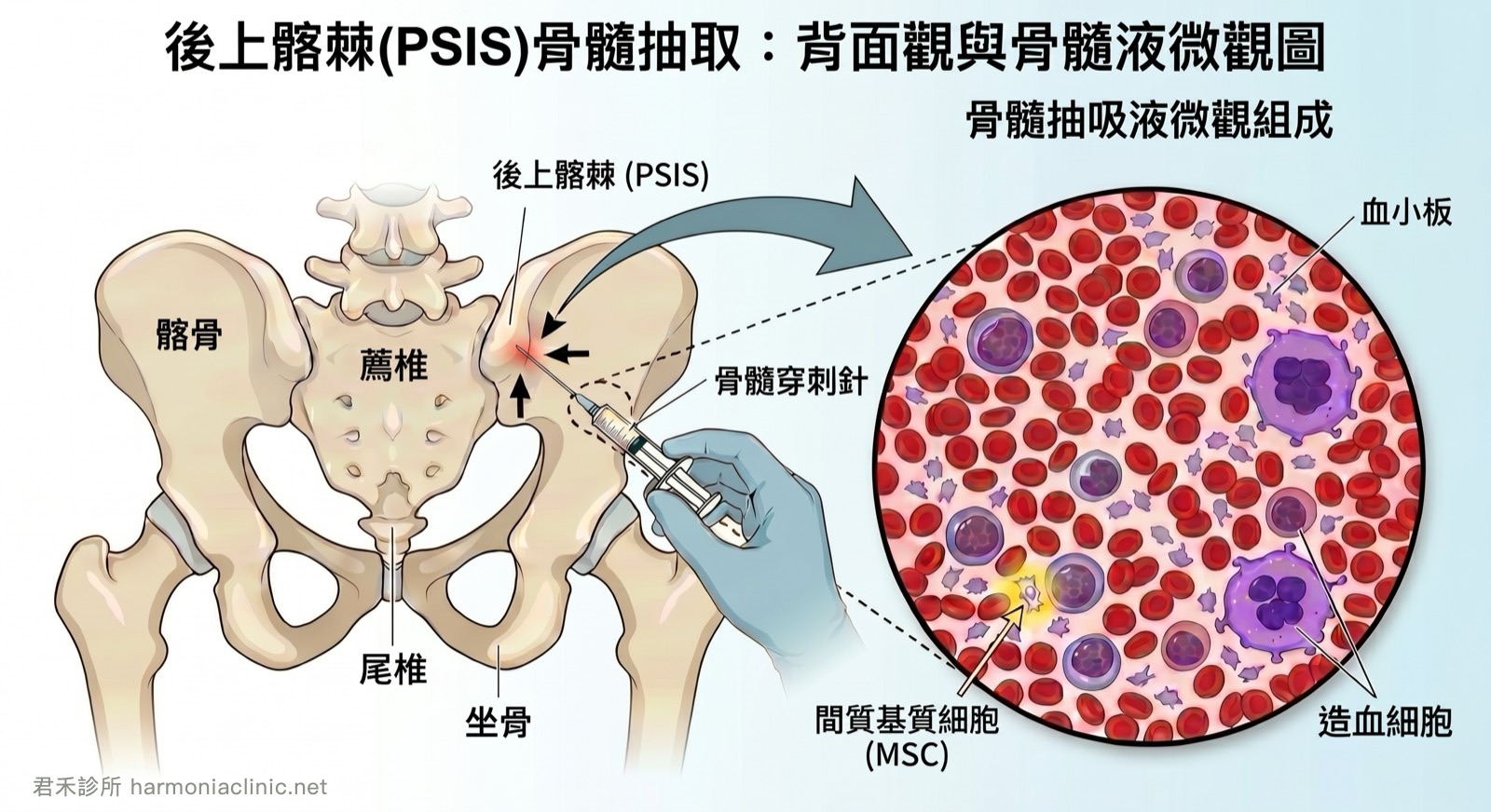自體骨髓再生注射（BMA）：治療前你會想知道的事