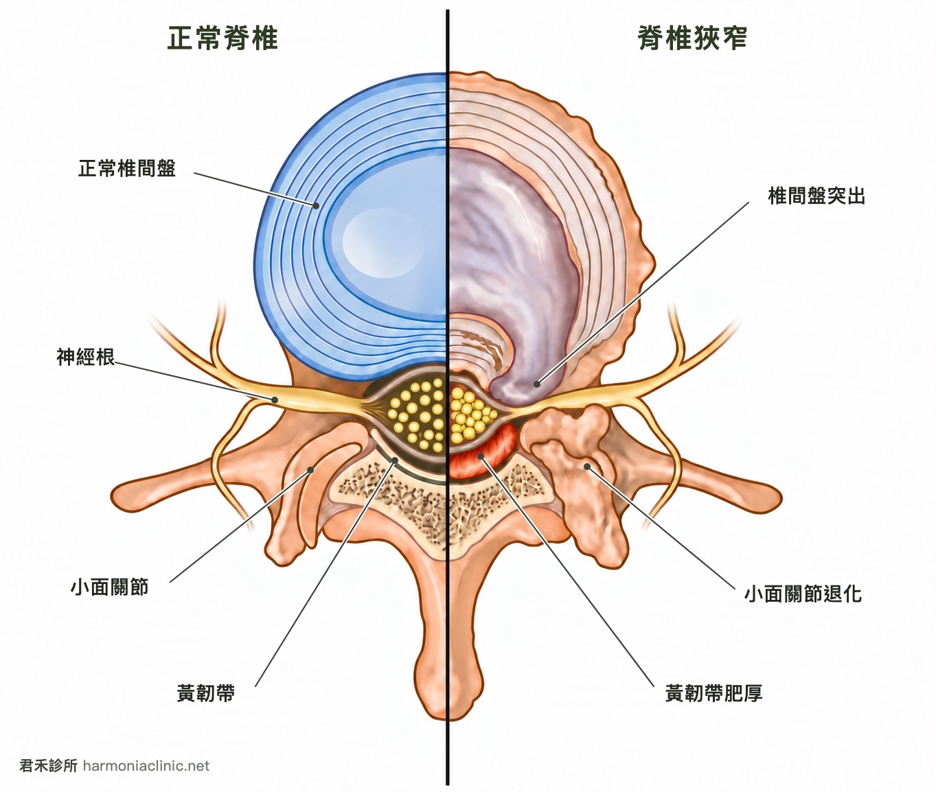 腰椎狹窄一定要開刀嗎？決定的關鍵不是狹窄的程度